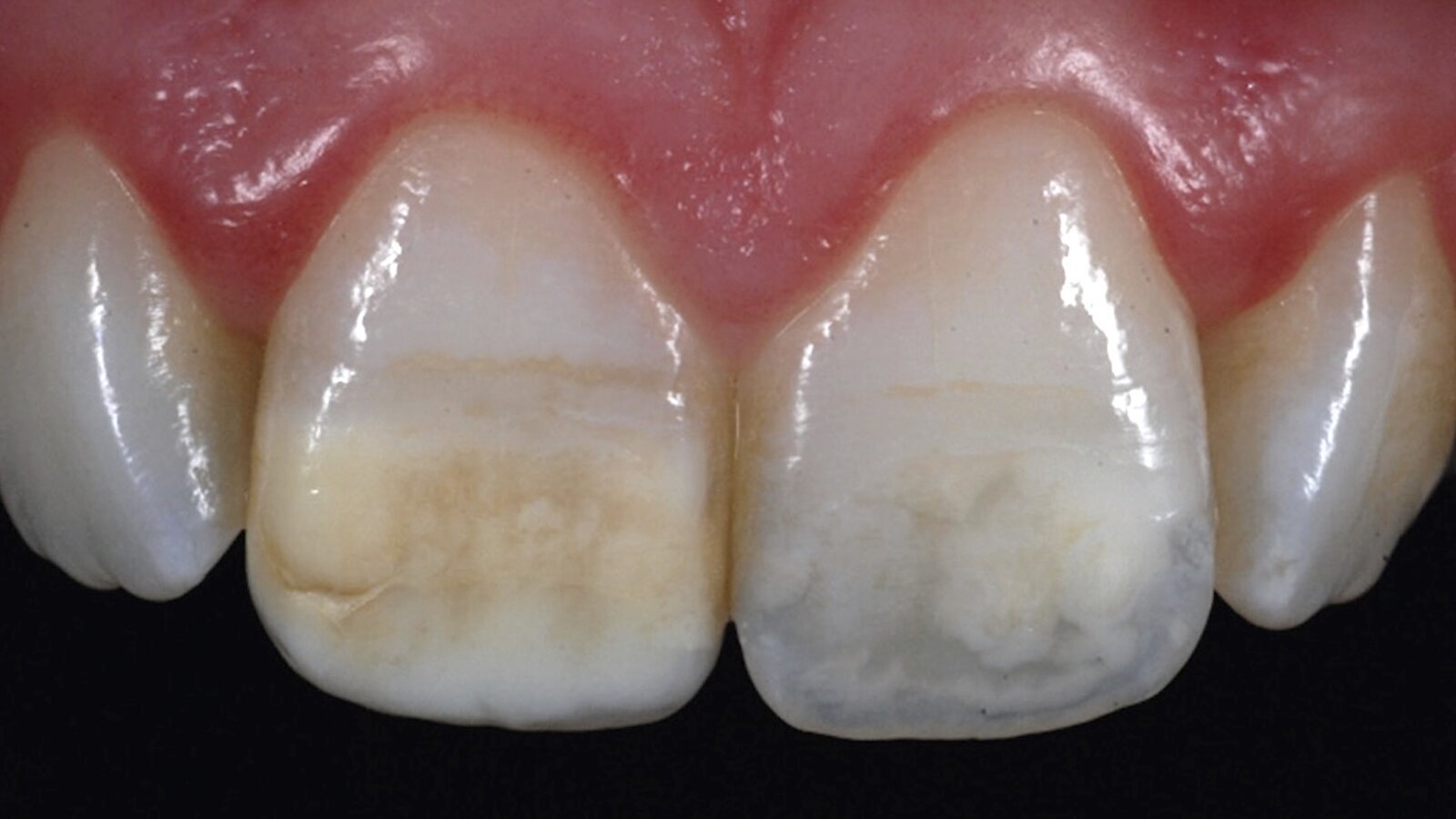 Estética y blanqueamiento dental en la era digital  (Capítulo 6)