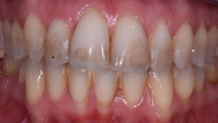 Fig. 3 - Pigmenti sulla superficie dello smalto a T0.