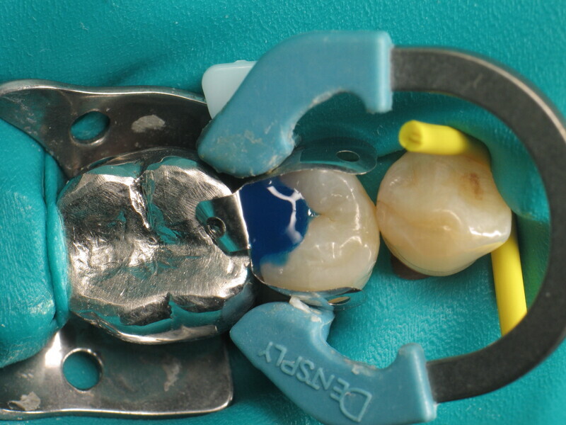 Fig. 5 : Mordançage de l’émail et de la dentine.