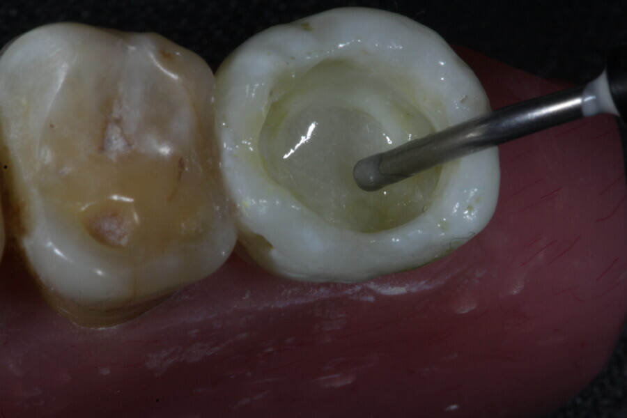 Fig. 23b: The space created by removing the gutta-percha is filled with a fibre-reinforced flowable composite (Fibrafill FLOW).