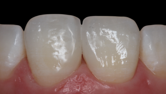 Fig. 12: Result immediately after removing the rubber dam