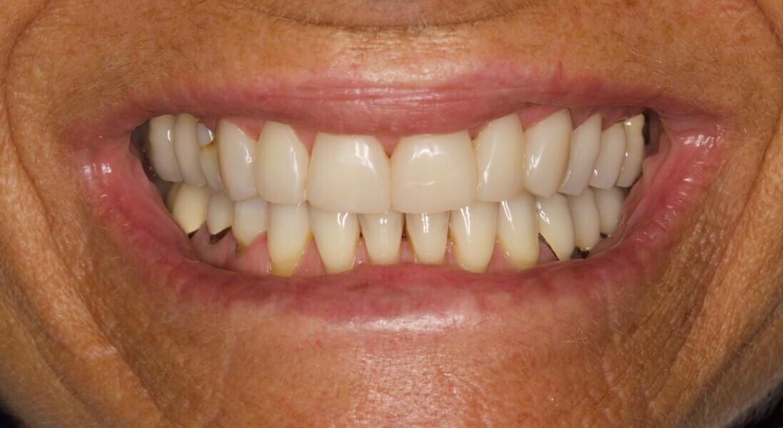 Fig. 14b: New smile.