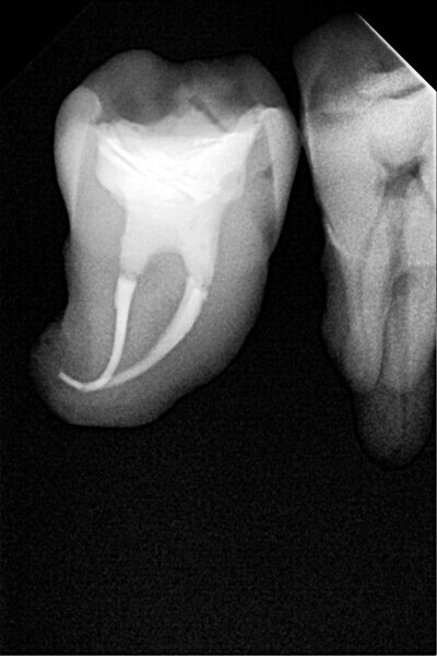 Fig. 29: Radiograph after reinforcement with the fibre filling materials.