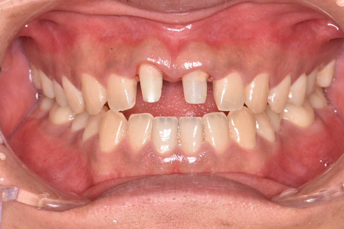 Fig. 4b: Prepared maxillary central incisors.