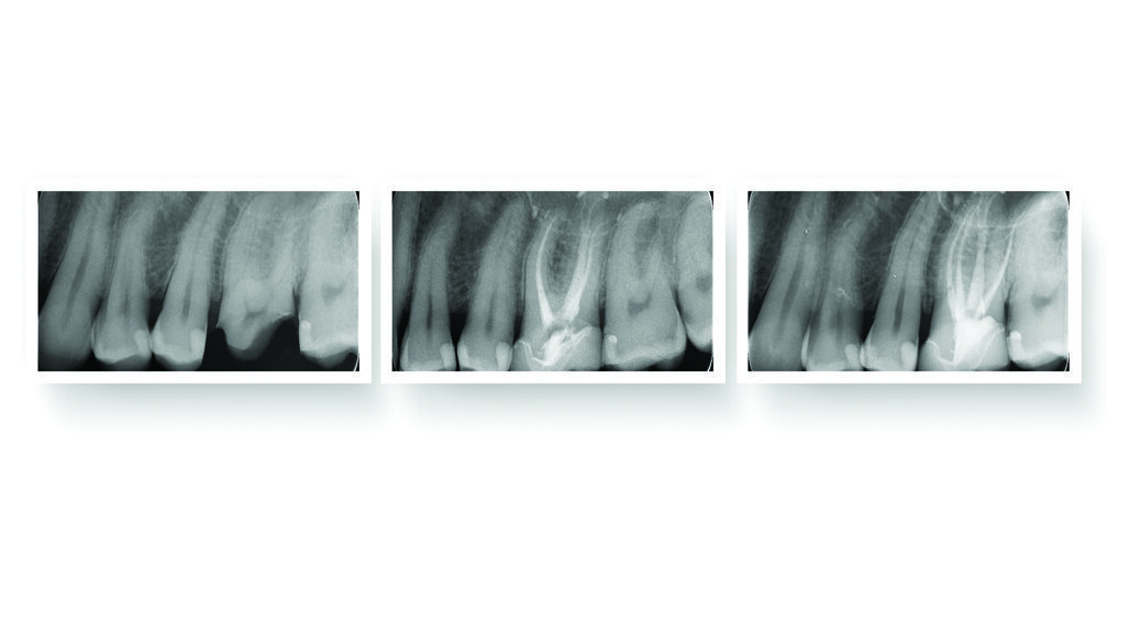 Revolutionizing Endodontics with Fotona SWEEPS Technology