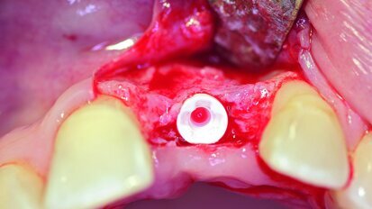 Single-tooth restoration using an all-ceramic implant solution