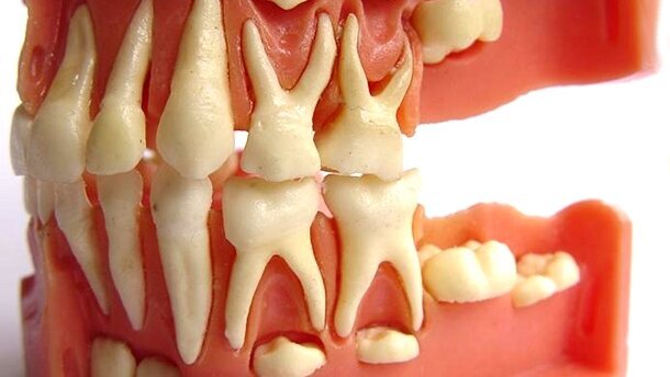 Odonto Ideias Nº 12: Banco de Dentes Humanos