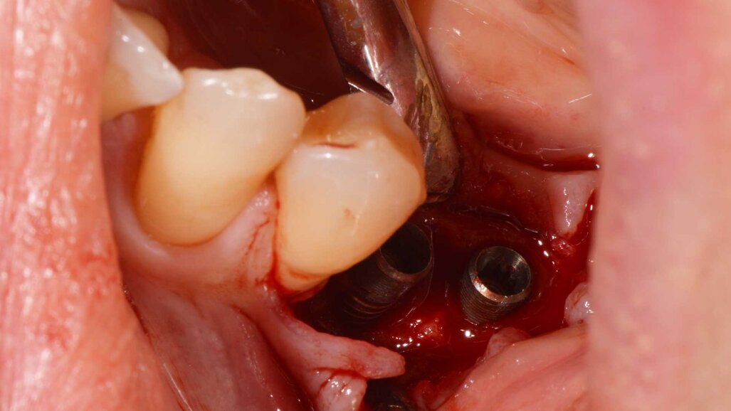 Trattamento (Biorigenerazione) di una doppia perimplantite nella mandibola posteriore con “Collagen-Ring Technique” e gel a base  di polinucleotidi e acido ialuronico
