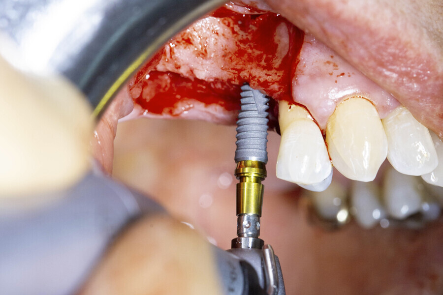 Fig. 4: Placement of the OmniTaper EV implant in position #15 using the TempBase driver.