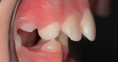 Pre-orthodontic options for 21st century parents
