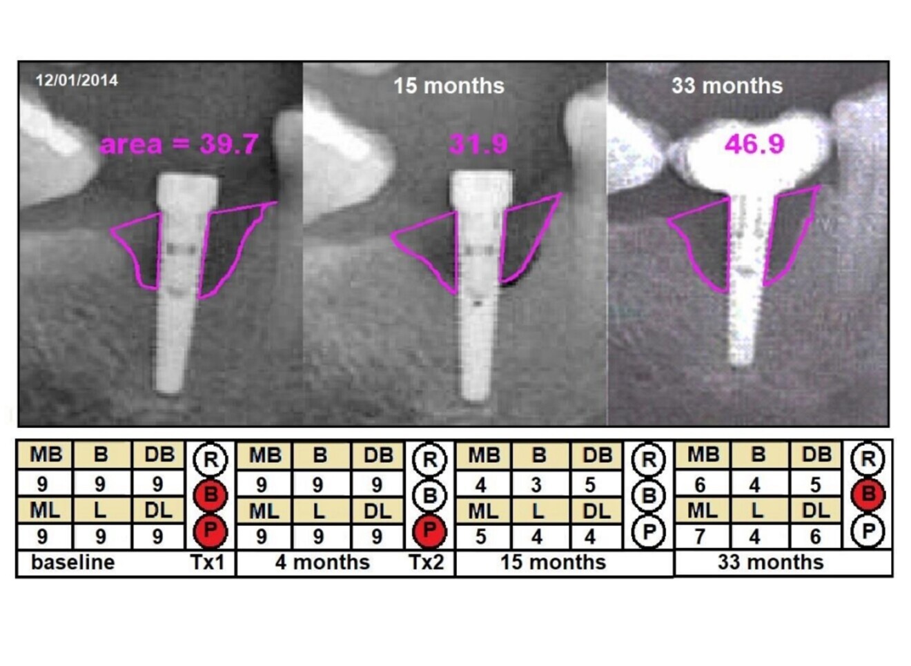 Fig. 3: Example of a partial response to treatment (Case 2), showing changes in radiographic defect (mm2), probing depth (PD; mm) and clinical signs from baseline to 33 months later. Violet = cross-sectional area; MB = mesiobuccal PD; B = buccal PD; DB = distobuccal PD; ML = mesiolingual PD; L = lingual PD; DL = distolingual PD; R = redness; B = bleeding; P = suppuration; Tx1 = first treatment; Tx2 = second treatment.