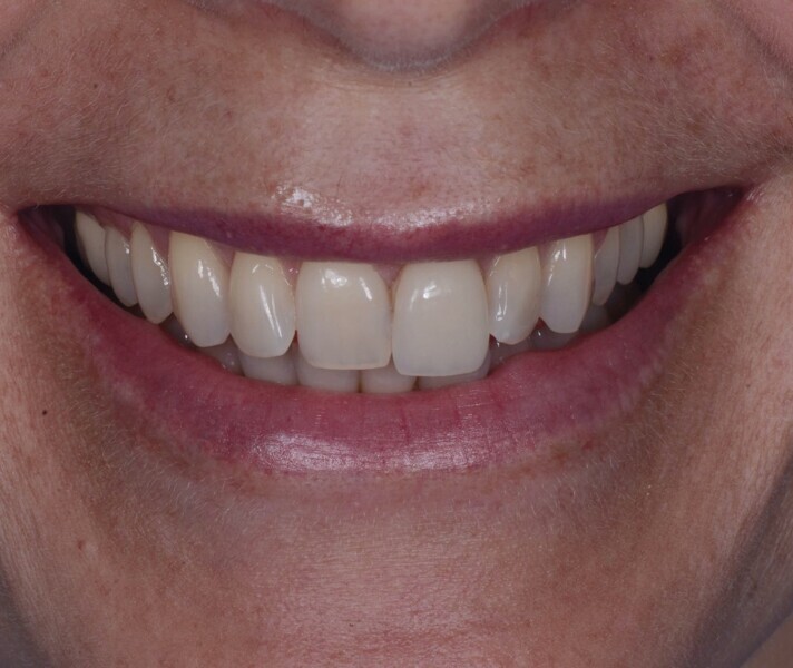 Fig. 21a : Sourire avant le traitement.