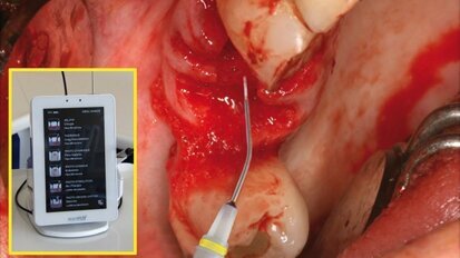Chirurgie reconstructrice lasers assistée en omnipratique