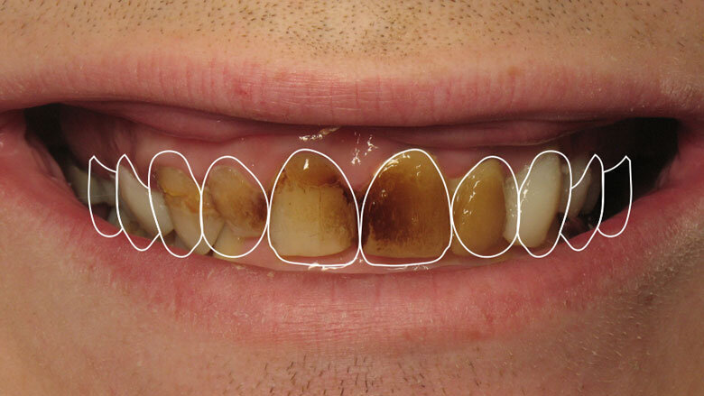Figura 2. Simulación numérica de la sonrisa basada en la situación inicial