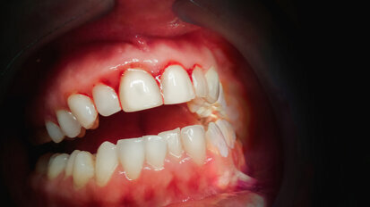 Oxidative stress links periodontal and chronic kidney disease