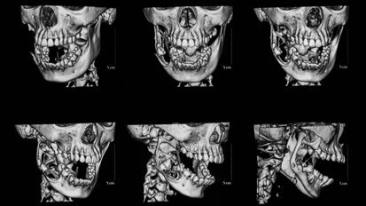 Orthodontic treatment planning without radiation exposure