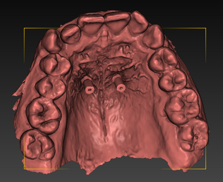 Fig. 2: Registration of implant positions using an intra-oral scan with the scan body system. 