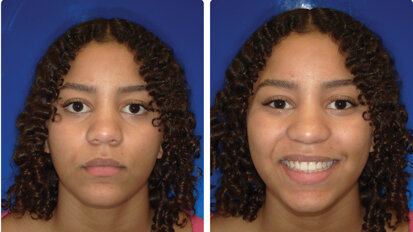 Unilateral Class II correction in less than a year using leading edge aligners