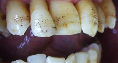 Er:YAG laser conditioning of hypoplastic enamel