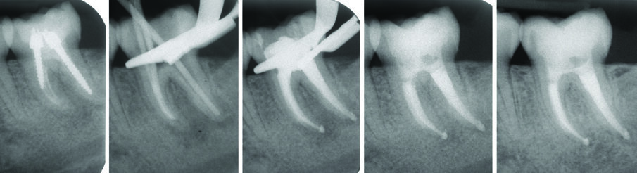 Fig. 9 - Ritrattamento canalare 3.7 controllo a 7 anni.
