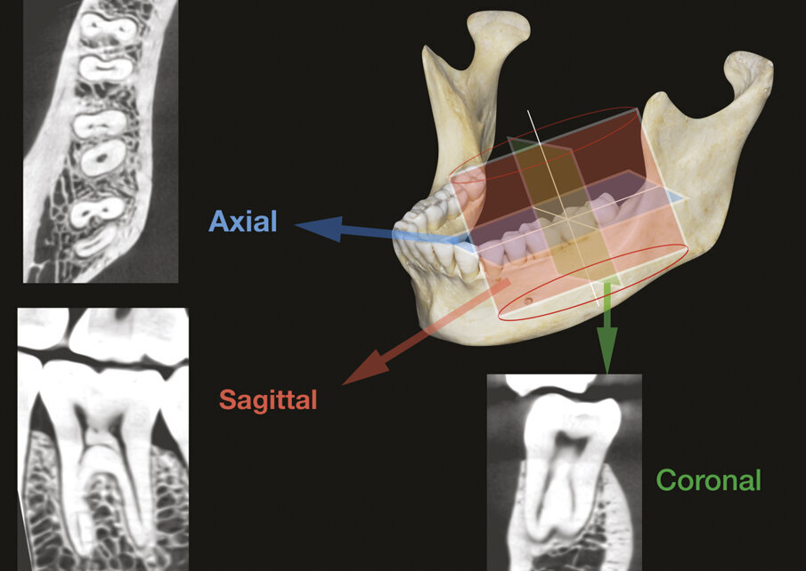 Figg. 4a-4c - La CBCT offre la possibilità di fornire e immagazzinare immagini radiografiche leggibili su vari piani sia orizzontali che verticali: assiale, sagittale e coronale.