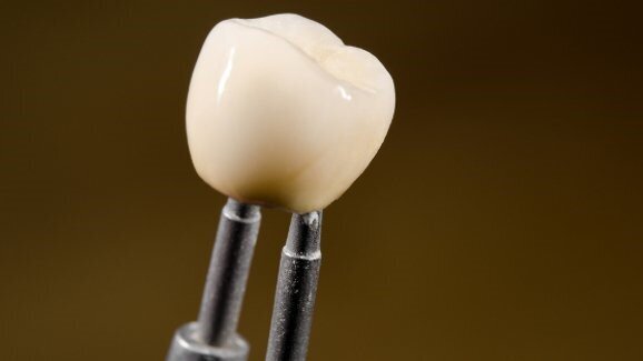 Nieuw licht op slijtage van keramische materialen bij melkgebitrestauratie