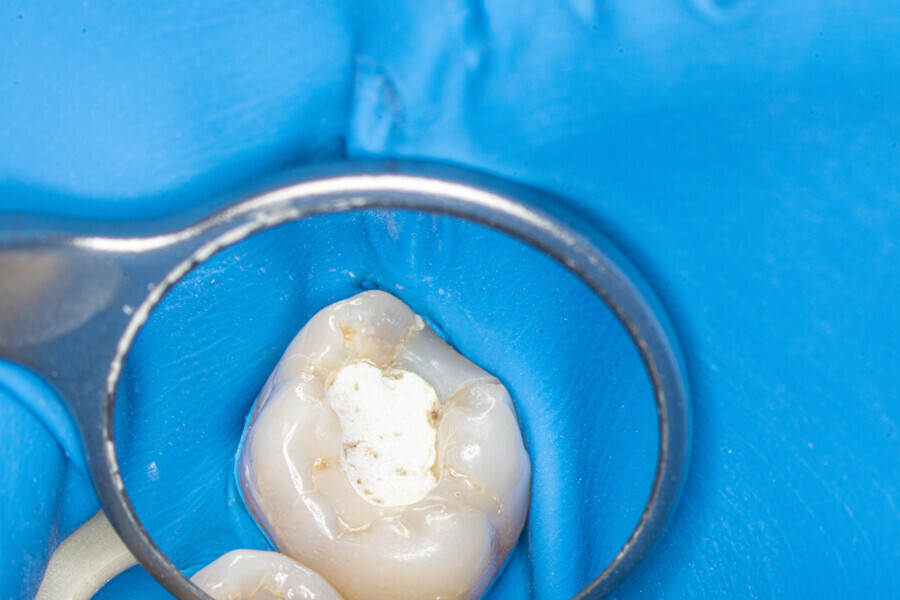 Fig. 10: The maxillary first molar with the temporary restoration before treatment.