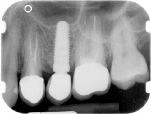 Fig. 17 - Radiografia di controllo a 1 anno dal carico.