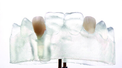 The complete digital implant  workflow