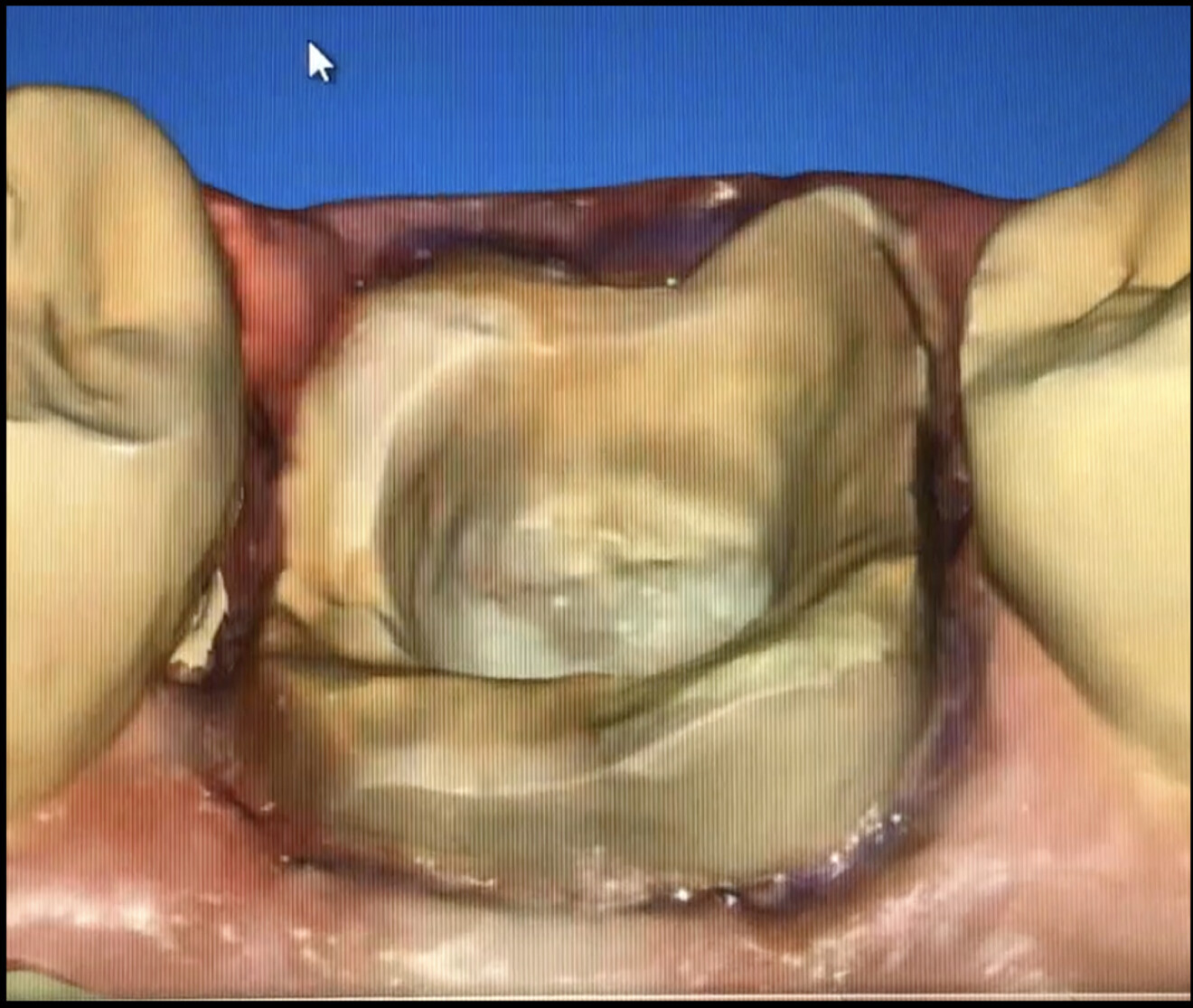 Fig. 12a & b: Margins and various details of the cavity preparation well captured in the digital impression.