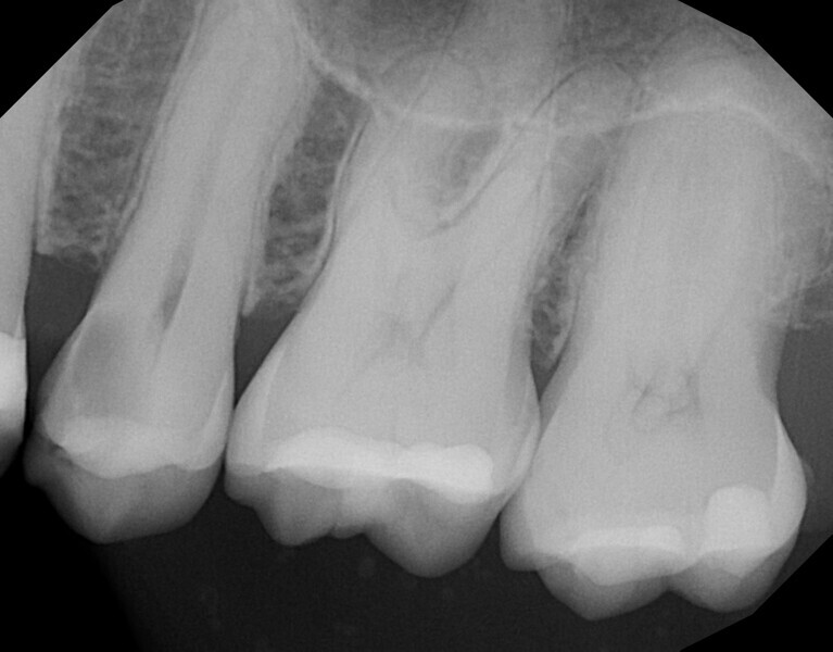 Fig. 2: Periapical radiograph of tooth #25, showing caries in close proximity to the pulpal tissue.