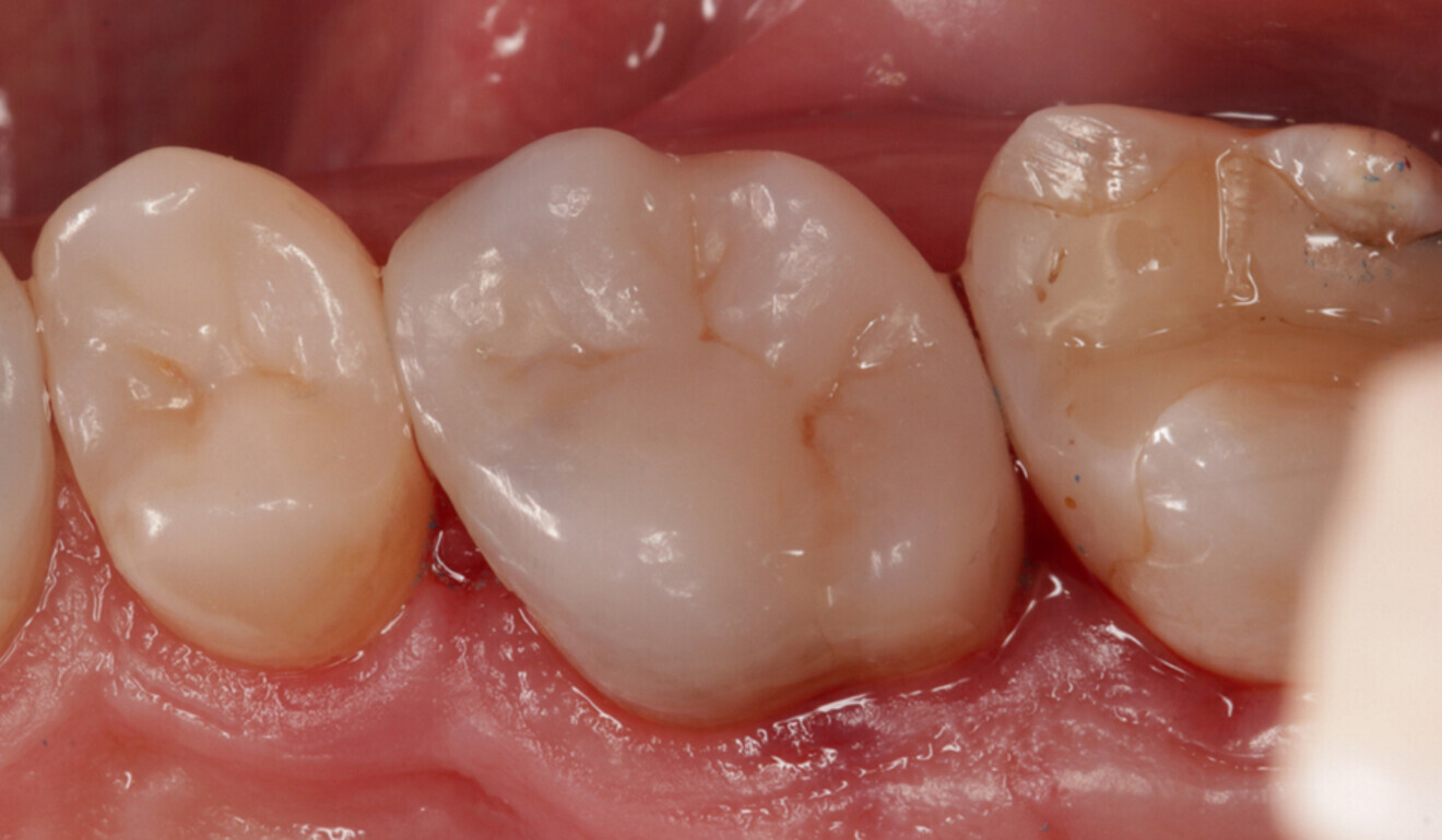 Fig. 21: Final effect, palatal view. (Image: Kuraray Noritake Dental)