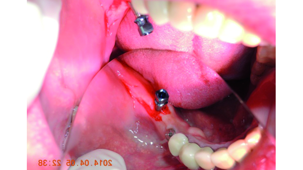 The indispensable use of CBCT in the posterior mandible