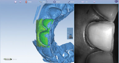 Click here! Digital impression margination made easy