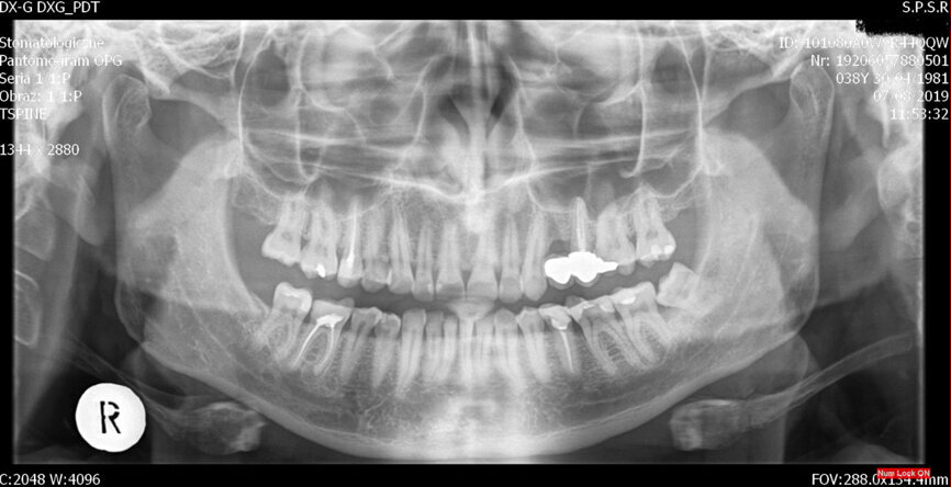 Fig. 1: Panoramic radiograph.