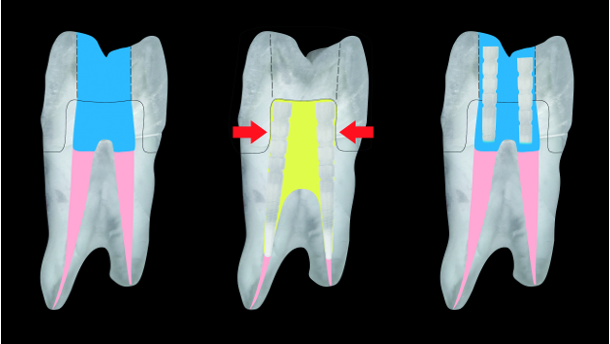 Rationale for the suggested use of fibre post segments in composite core build-ups for endodontically treated teeth