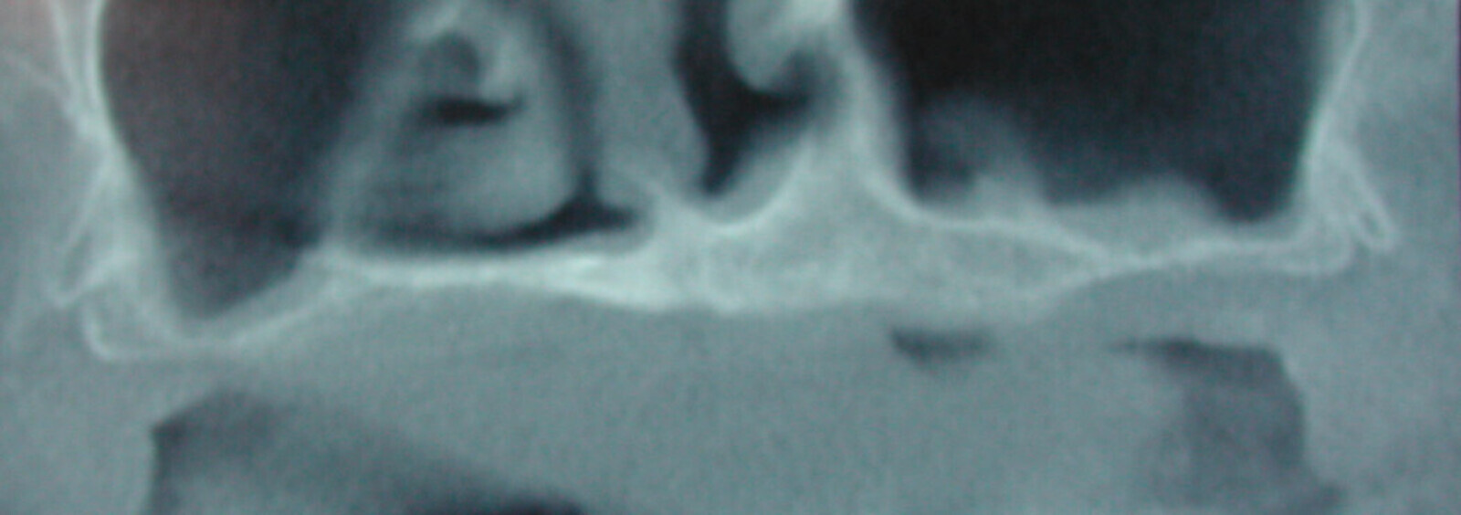 Fig. 5a : Cas d’une atrophie majeure maxillaire. 