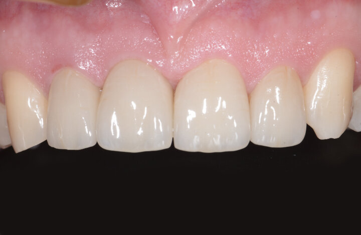 Fig. 18: There was perfect adaptation of the soft tissue around the implant restoration. In addition, a ceramic crown
was placed on tooth #12 (after root canal therapy) and ceramic veneers on teeth #21 and 22. Three years follow up shows stability of soft and hard tissue.