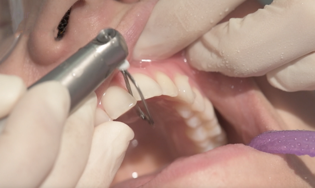 Fig. 9: Using an oscillating handpiece with water spray for IPR in the maxillary arch.