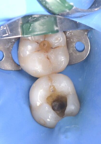 Fig. 3: Typical amalgam staining visible at the bottom of the larger cavity. 