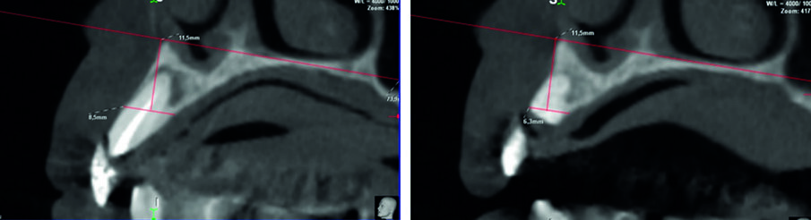 Figg. 6a, 6b_Misura degli spessori ossei. Viene mostrata a titolo esemplificativo la misura eseguita a livello dell’elemento 1.2. (A) sulla CBCT acquisita prima dell’estrazione si traccia una retta passante per la base del palato; successivamente si traccia una retta parallela alla prima, in posizione più coronale, dove si misura lo spessore osseo. (B) per misurare lo spessore osseo prima del posizionamento implantare si identifica la sezione corrispondente della seconda CBCT, sulla quale si riporta la stessa costruzione geometrica e si procede alla misura dello spessore osseo.