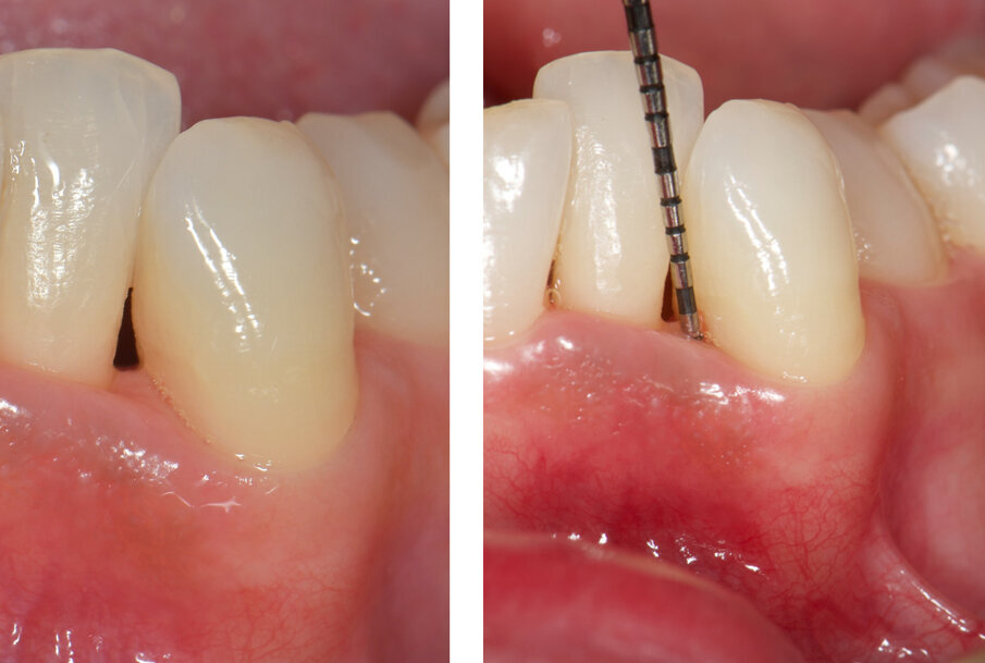 Fig. 7 - Visione frontale del difetto trattato a 30 giorni di follow-up. I parametri parodontali sono migliorati: PPD di 3 mm e CAL 4 mm. L’aspetto clinico dei tessuti è significativamente migliorato. L’edema della fase iniziale è rientrato e si nota una depressione al centro della papilla che evidenzia una fase avanzata della guarigione.