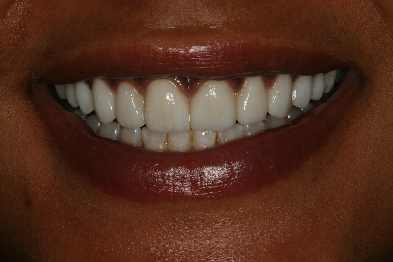 Fig. 8: Post-op full smile. 