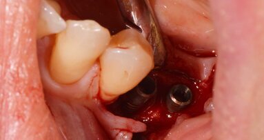 Trattamento (Biorigenerazione) di una doppia perimplantite nella mandibola posteriore con “Collagen-Ring Technique” e gel a base  di polinucleotidi e acido ialuronico