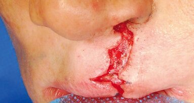 Prothetisch-ästhetische Rehabilitation bei LKG-Spalte im Erwachsenenalter