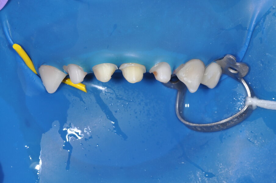 Fig. 4: Crown preparations with margins kept supra-gingival.
