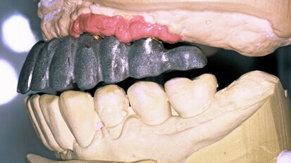 Full-Arch Implant-Retained-Restoration. Fixed or Removable?
