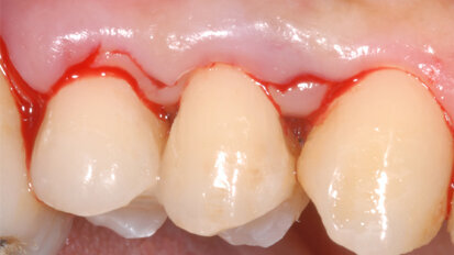 Single Flap Approach. Un approccio chirurgico semplificato ai difetti ossei parodontali