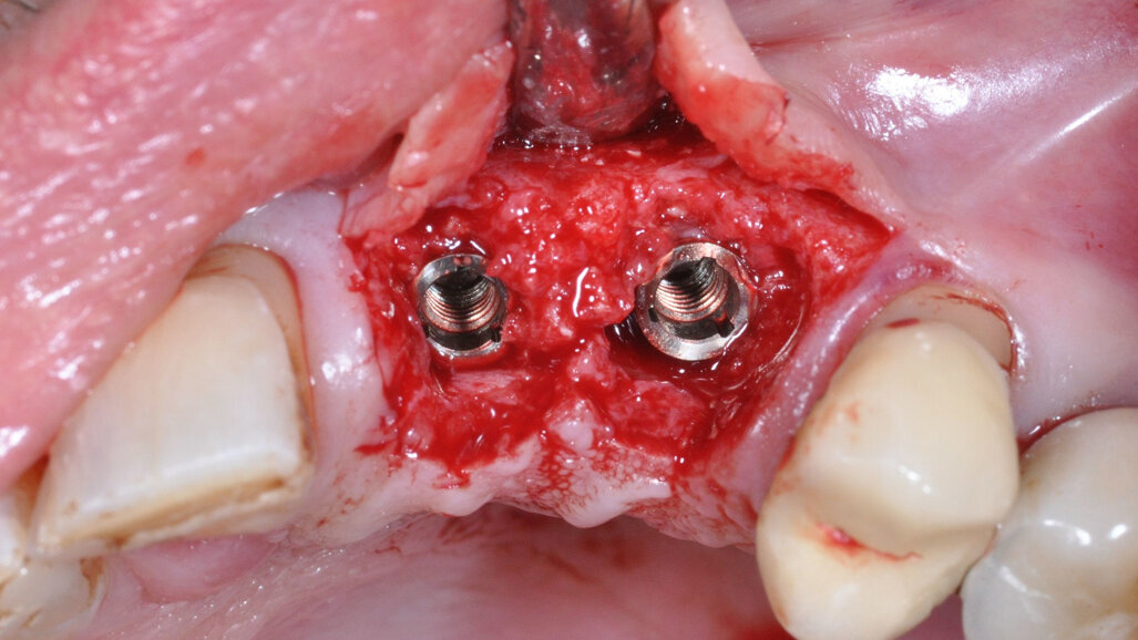 IADSR awards one-year diploma in Periodontology, Implantology 