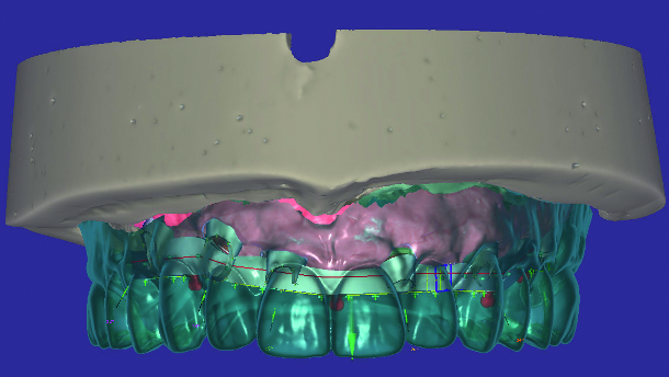 Removable prosthesis in digital times